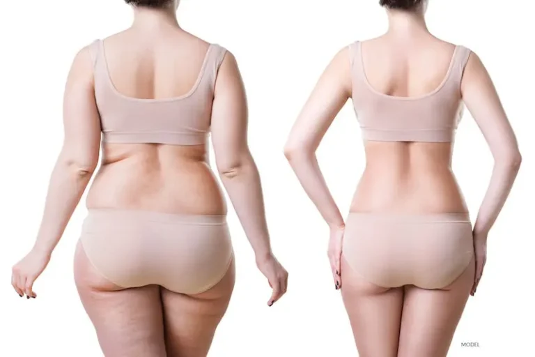 Liposuction surgeon in Gurgaon